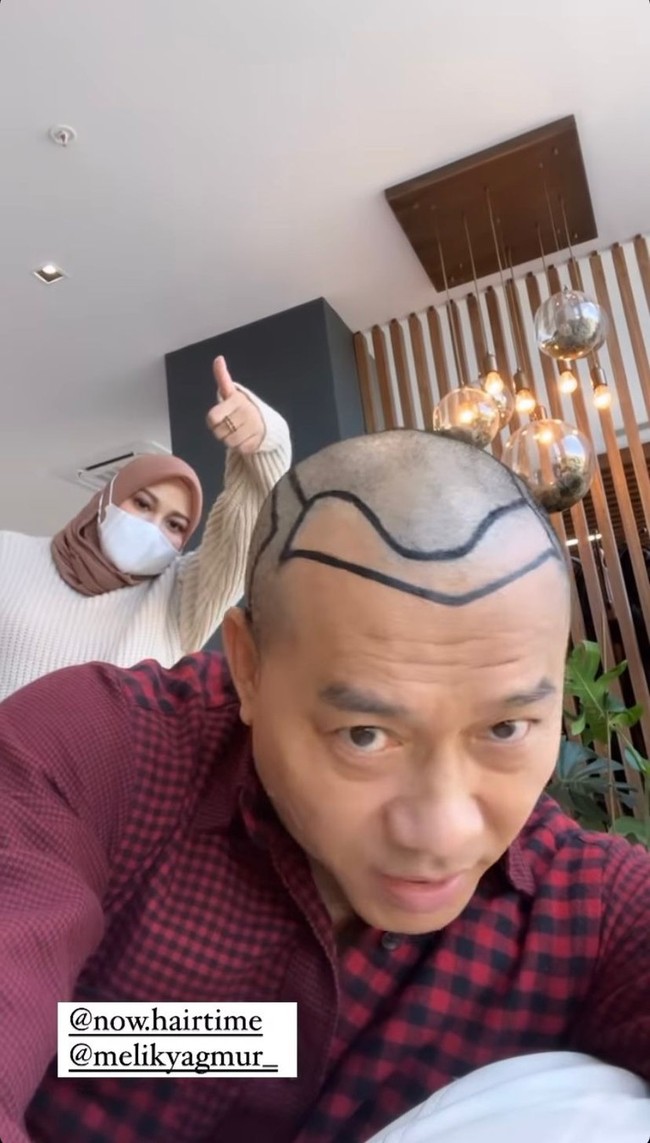 Transplantasi rambut itu dilakukan oleh Anang saat dirinya sedang berlibur di Turki. Aurel Hermansyah pun tampak hadir dan menemani sang ayah tercinta. Foto: Instagram/@ananghijau