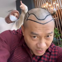 Transplantasi rambut itu dilakukan oleh Anang saat dirinya sedang berlibur di Turki. Aurel Hermansyah pun tampak hadir dan menemani sang ayah tercinta. Foto: Instagram/@ananghijau