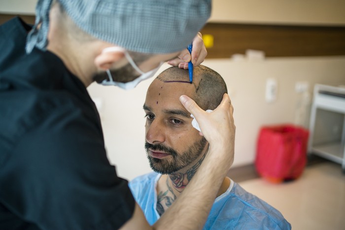 cangkok rambut atau transplantasi rambut