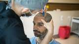 Apakah Transplantasi Rambut Efektif Atasi Kebotakan? Ini Penjelasannya