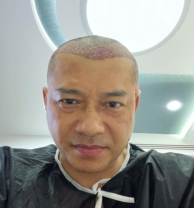 Anang Hermansyah menjalani transplantasi rambut di Turki. Ayah empat anak ini ingin rambutnya lebih lebat di usia yang sudah menginjak kepala lima. Foto: Instagram/ananghijau