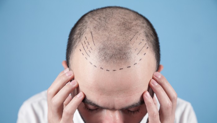 Tanpa Transplantasi Rambut, 5 Bahan Makanan Ini Bisa Atasi Kebotakan