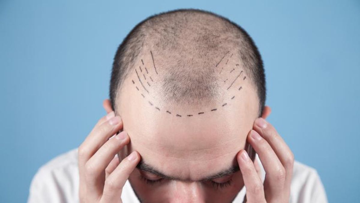 Pria Ini Meninggal usai Jalani Transplantasi Rambut, Kok Bisa?