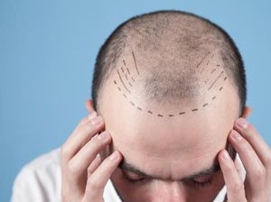 Tanpa Transplantasi Rambut, 5 Bahan Makanan Ini Bisa Atasi Kebotakan