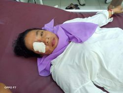 Wanita di Asahan Nyaris Buta Disiram Air Keras Suaminya