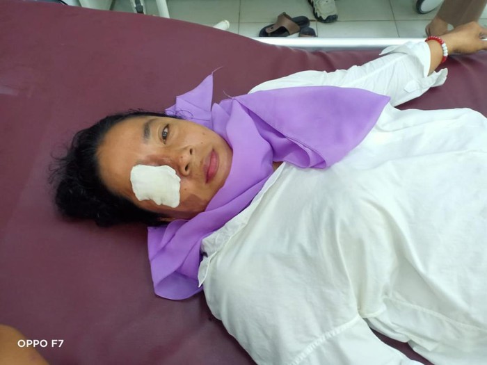 Wanita di Asahan nyaris buta akibat disiram air keras oleh suaminya