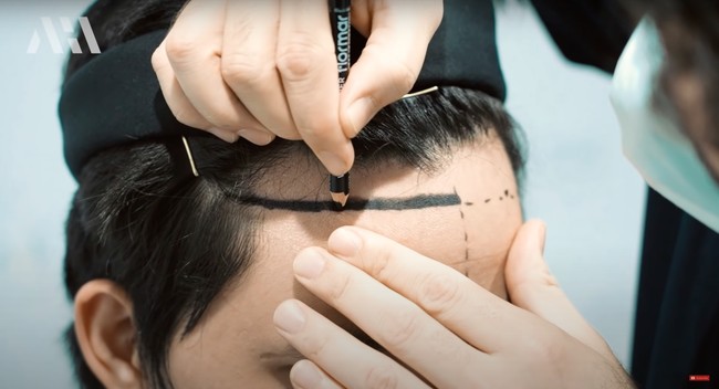 Awalnya Atta Halilintar berencana untuk melakukan transplantasi hingga ke bagian jambang. Namun ternyata dirinya tak kuat menahan rasa sakit dari proses transplantasi tersebut. Hingga akhirnya Atta pun membatalkan transplantasi rambut di bagian jambangnya. Foto: YouTube/AH