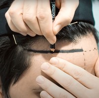 Awalnya Atta Halilintar berencana untuk melakukan transplantasi hingga ke bagian jambang. Namun ternyata dirinya tak kuat menahan rasa sakit dari proses transplantasi tersebut. Hingga akhirnya Atta pun membatalkan transplantasi rambut di bagian jambangnya. Foto: YouTube/AH