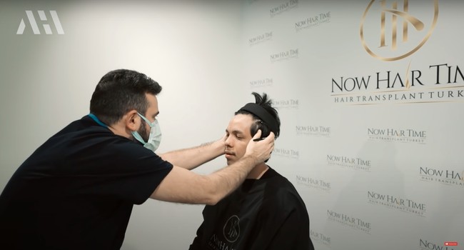 Atta Halilintar akhirnya memutuskan untuk menjalani transplantasi rambut karena dirinya merasa tidak percaya diri dengan jidatnya yang lebar. Atta merasa bahwa rambutnya itu tumbuh terlalu ke belakang. Sehingga dengan menjalani transplantasi rambut dia berharap bisa semakin percaya diri. Foto: YouTube/AH