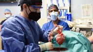 Pasien Pertama Penerima Cangkok Jantung Babi Meninggal, Ini Kata Ahli