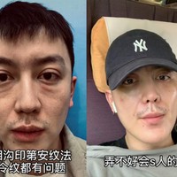 Harusnya bisa bikin awet muda, sayangnya hasil fat grafting pada Abel malah terlihat sebaliknya. Dalam foto before-after, tampak jelas jika bagian bahwa matanya jadi seperti kendur sehingga malah jadi lebih tua. Aku benar-benar menua lebih dari 20 tahun. Awalnya aku hanya mau terlihat bagus, tapi sekarang aku menjadi monster yang jelek, katanya. Foto: Douyin/Weibo Jin Dawei