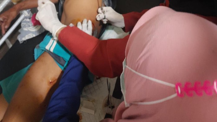 Abdul Gani saat menjalani perawatan di Puskesmas usai digigit buaya berukuran 3 meter (dokumen istimewa)