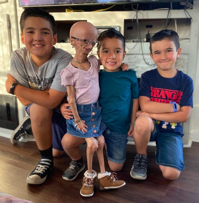 Remaja asal Texas, AS itu memiliki tubuh yang kecil, dan memiliki kulit keriput. Adalia pun tak memiliki rambut. Tinggi tubuhnya bahkan lebih mungil dibanding ketiga adiknya. Foto: dok. Instagram/@adalia06