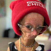Adalia Rose meninggal dunia di usia 15 tahun pada Selasa (12/1/2022). Dia memiliki penyakit langka yakni Hutchinson-Gilford progeria yang juga disebut sebagai sindrom ‘Benjamin Button’ setelah film berjudul The Curious Case of Benjamin Button yang diperankan oleh Brad Pitt. Dalam karakter tersebut, Benjamin tumbuh terbalik dari orang umumnya yang semakin lama dirinya semakin mengecil. Foto: dok. Instagram/@adalia06