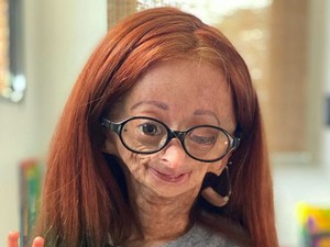 Youtuber 15 Tahun Meninggal Idap Penyakit Benjamin Button, Kondisi Apa Itu?