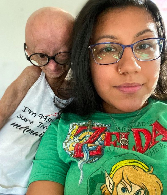 Ibu Adalia, Natalia Pallente pernah menceritakan 2018. Di awal bulan setelah kelahirannya, dokter menyadari ada sesuatu yang salah dengan kondisi kesehatannya. Pada tiga bulan, Adalia mendapatkan diagnosisnya, dan setelah itu mulai mengalami kerontokan rambut. Pembuluh darahnya juga menjadi terlihat, dan kulitnya menipis.Foto: dok. Instagram/@adalia06