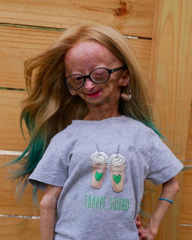 Begitu juga dengan Adalia. Sindrom tersebut menyebabkan penuaan yang cepat terjadi. Padahal ketika lahir, Adalia tampak normal. Foto: dok. Instagram/@adalia06