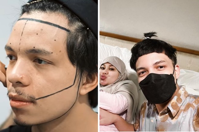 Begitu juga dengan menantunya Atta Halilintar yang melakukan hair transplant. Setelah transplantasi rambut, suami Aurel Hermansyah itu tidak lagi menggunakan bandana. Foto: Dok. Instagram, Youtube