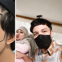 Begitu juga dengan menantunya Atta Halilintar yang melakukan hair transplant. Setelah transplantasi rambut, suami Aurel Hermansyah itu tidak lagi menggunakan bandana. Foto: Dok. Instagram, Youtube