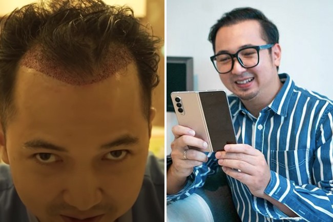 Youtuber Edho Zell juga melakukan transplantasi rambut. Garis rambut yang semakin lama semakin mundur ternyata mempengaruhi kepercayaan dirinya. Foto: Dok. Instagram, Youtube