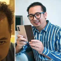 Youtuber Edho Zell juga melakukan transplantasi rambut. Garis rambut yang semakin lama semakin mundur ternyata mempengaruhi kepercayaan dirinya. Foto: Dok. Instagram, Youtube