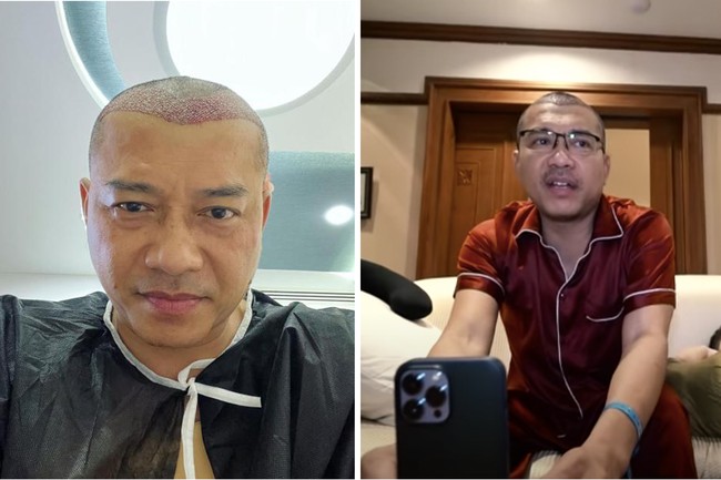 Saat liburan baru-baru ini ke Turki, Anang Hermansyah sekaligus melakukan transplantasi rambut. Inilah foto before afternya. Foto: Dok. Instagram, Youtube