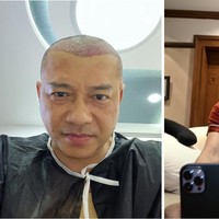 Saat liburan baru-baru ini ke Turki, Anang Hermansyah sekaligus melakukan transplantasi rambut. Inilah foto before afternya. Foto: Dok. Instagram, Youtube