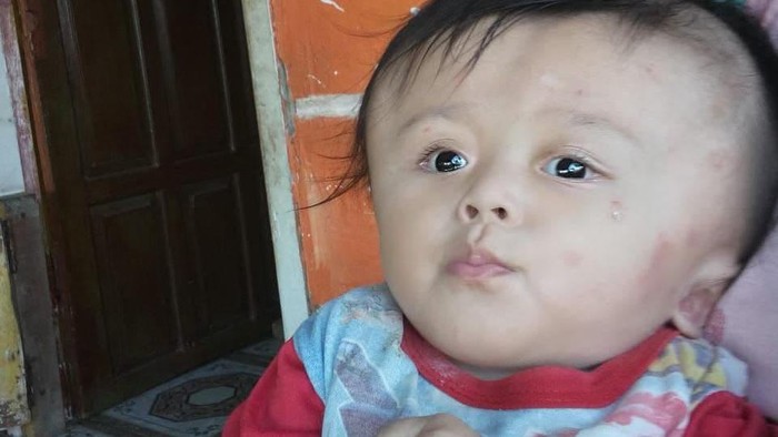 Bayi Vivi penderita hidrosefalus butuh operasi Bayi Vivi penderita hidrosefalus butuh operasi