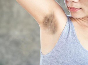 5 Bahan Alami Ini Bisa Cerahkan Ketiak yang Hitam