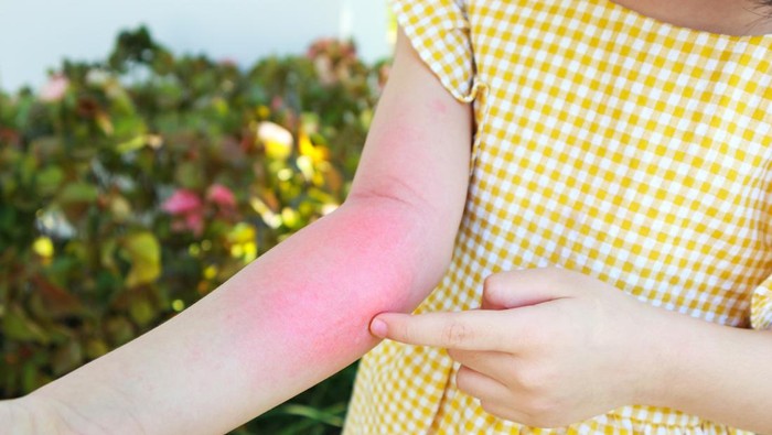 7 Obat Biduran Alami yang Ada di Dapur, Bantu Redakan Gatal dengan Cepat