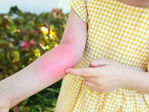 3 Golongan Alergi pada Anak dan Dampaknya