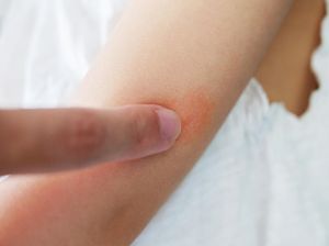 9 Cara Menghilangkan Biduran dengan Cepat Secara Alami dan Tanpa Obat
