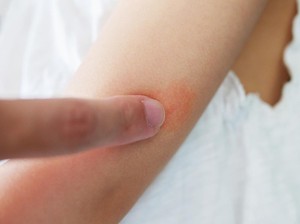 9 Cara Menghilangkan Biduran dengan Cepat Secara Alami dan Tanpa Obat