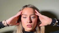 Di Instagram, Harriet Robson memperlihatkan wajah cantiknya penuh luka. Foto: Dok. Instagram
