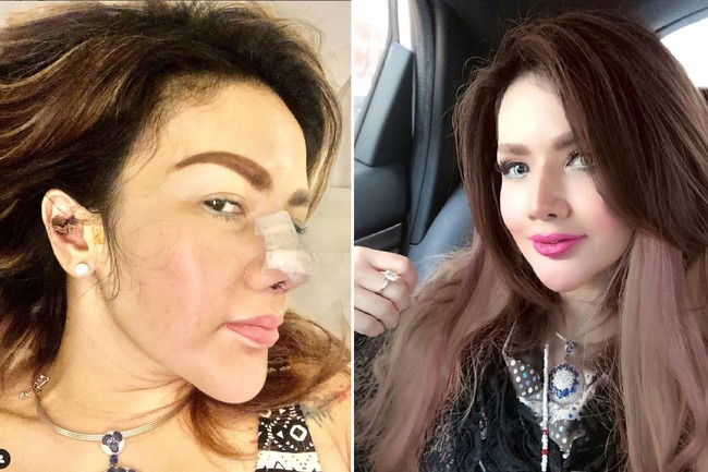 Artis Indonesia yang melakukan operasi hidung terbaru adalah Barbie Kumalasari. Rhinoplasty bukan hal baru bagi Barbie Kumalasari dia melakukannya sudah enam kali. Kali ini dia melakukan operasi hidung karena implan hidung sebelumnya harus diganti akibat penipisan kulit. Untuk operasi hidung terbaru, Barbie mengaku telah menghabiskan biaya 50 juta. Foto: Instagram/@barbiekumalasari