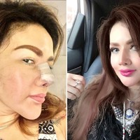 Artis Indonesia yang melakukan operasi hidung terbaru adalah Barbie Kumalasari. Rhinoplasty bukan hal baru bagi Barbie Kumalasari dia melakukannya sudah enam kali. Kali ini dia melakukan operasi hidung karena implan hidung sebelumnya harus diganti akibat penipisan kulit. Untuk operasi hidung terbaru, Barbie mengaku telah menghabiskan biaya 50 juta. Foto: Instagram/@barbiekumalasari