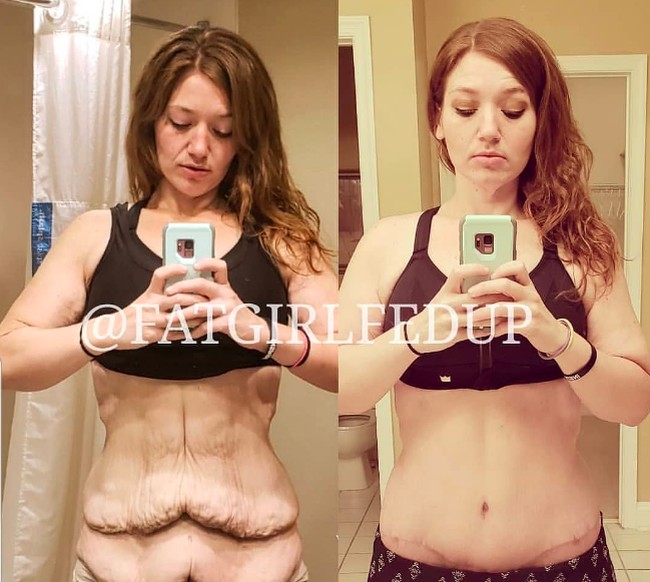 Karena penurunan badannya yang banyak, yang tersisa adalah kulit menggelambirnya. Di 2018 dia melakukan operasi penghilangan kulit untuk ‘menggunting’ kulit bergelambirnya. Foto: dok. Instagram/@fatgirlfedup