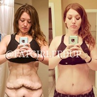 Karena penurunan badannya yang banyak, yang tersisa adalah kulit menggelambirnya. Di 2018 dia melakukan operasi penghilangan kulit untuk ‘menggunting’ kulit bergelambirnya. Foto: dok. Instagram/@fatgirlfedup