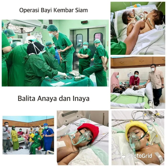 bayi kembar siam