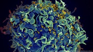 Pasien Ketiga HIV Berhasil Sembuh Berkat Terapi Sel Punca