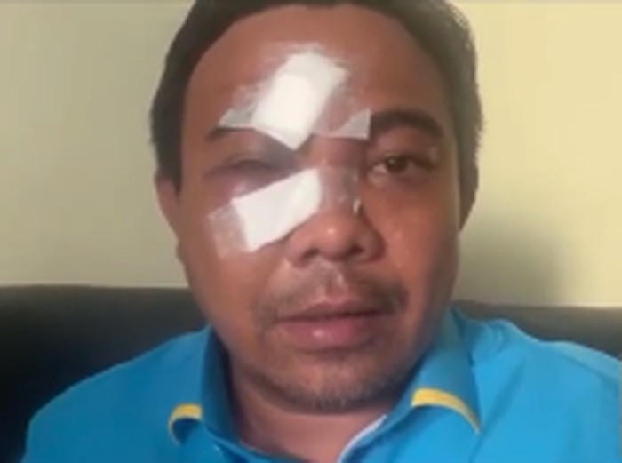 Ketua Umum (Ketum) KNPI Haris Pertama dipukuli orang tak dikenal (OTK) saat hendak makan di kawasan Cikini, Jakarta Pusat, Senin (21/2). Haris pun menduga ada dalang di balik pengeroyokan dirinya, sebab ia mengakui tidak pernah terlibat masalah dengan pelaku pengeroyokan.