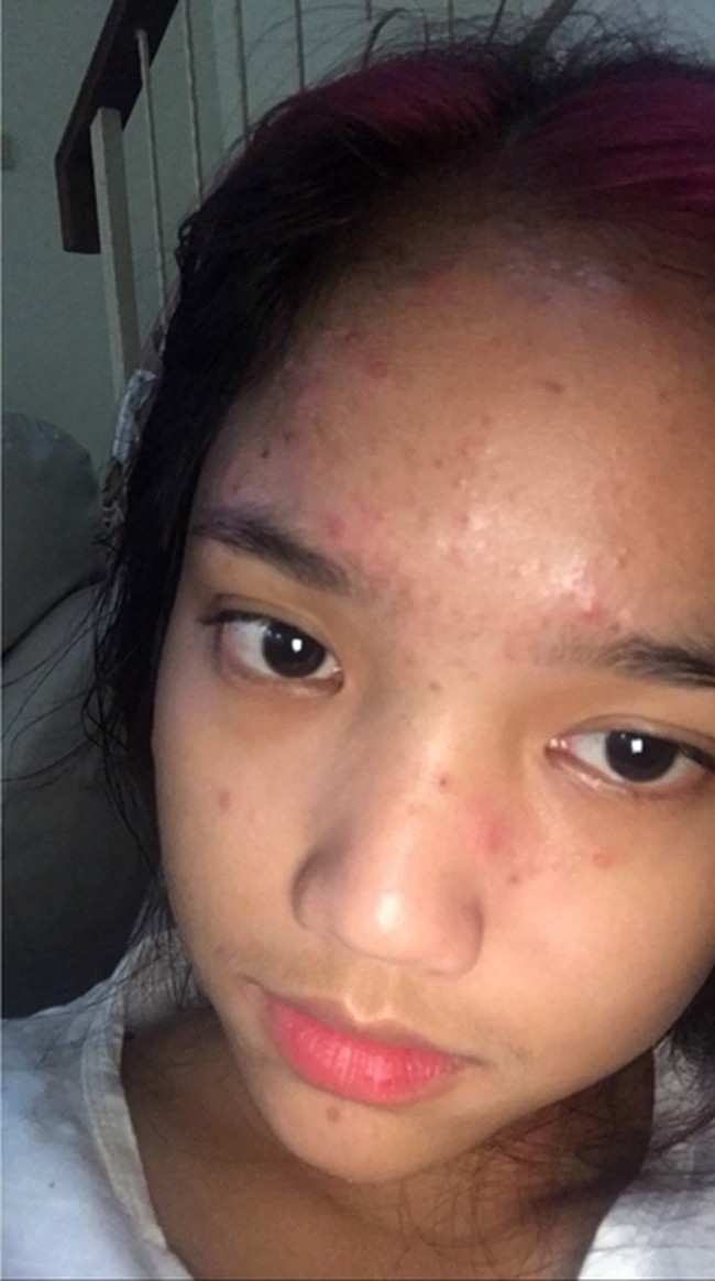 Seperti remaja pada umumnya, Fuji juga pernah merasakan jerawatan. Seperti yang terlihat dalam foto, bagian dahi dan bawah mata dekat hidung Fuji tampak dipenuhi dengan jerawat kecil-keciil. Foto: Instagram/@fuji_an