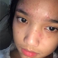 Seperti remaja pada umumnya, Fuji juga pernah merasakan jerawatan. Seperti yang terlihat dalam foto, bagian dahi dan bawah mata dekat hidung Fuji tampak dipenuhi dengan jerawat kecil-keciil. Foto: Instagram/@fuji_an