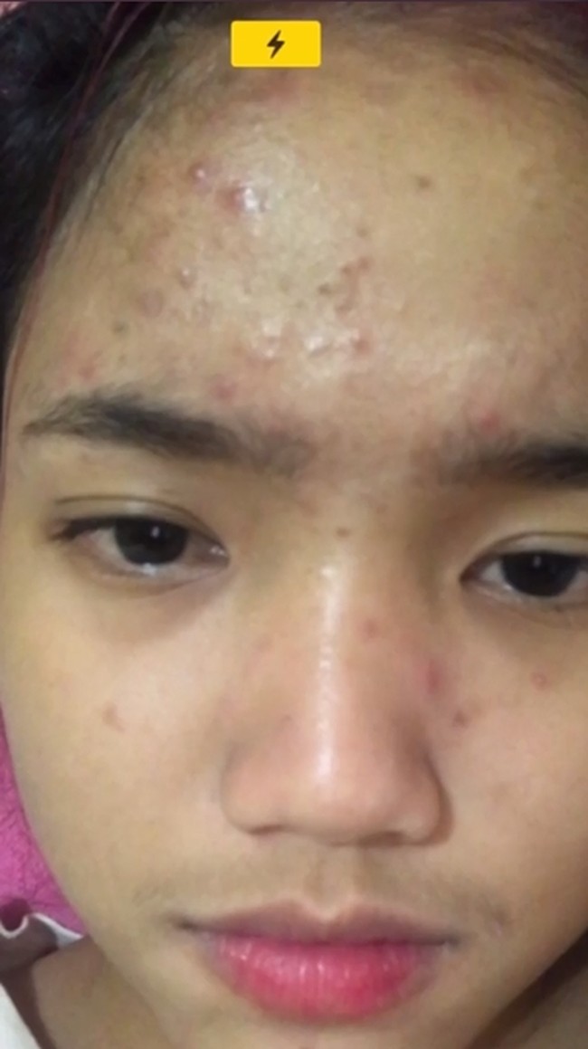 Jerawat-jerawat tersebut membuat wajah Fuji jadi terlihat merah-merah. Walaupun demikian, dirinya masih tetap terlihat cantik. Foto: Instagram/@fuji_an