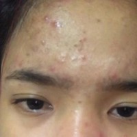 Jerawat-jerawat tersebut membuat wajah Fuji jadi terlihat merah-merah. Walaupun demikian, dirinya masih tetap terlihat cantik. Foto: Instagram/@fuji_an