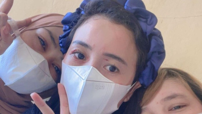 Selebgram di Pinrang Sulsel polisikan rekan kerja karena dikeroyok hingga wajah penuh luka cakar (Dok. Istimewa)