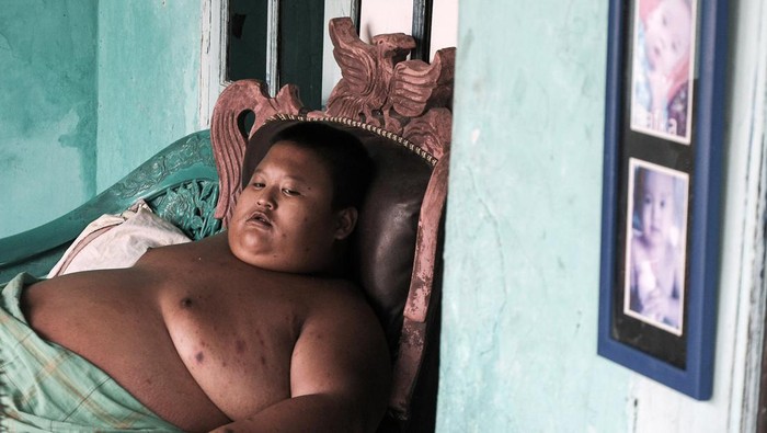 Penderita obesitas Rafka Adiputra (11) saat beristirahat di kediamannya di Desa Kedung Pengawas, Babelan, Kabupaten Bekasi, Jawa Barat, Kamis (10/3/2022). Rafka mengalami obesitas dari umur dua tahun dan saat ini berat badannya mencapai 115 kg. ANTARA FOTO/Fakhri Hermansyah/YU