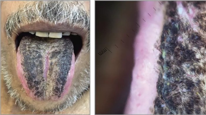 Kelainan pada lidah Lidah Pria Ini Menghitam dan Ditumbuhi Bulu usai mengalami stroke.