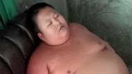 Viral Bocah 11 Tahun di Bekasi Alami Obesitas, Berat Badan 126 Kg