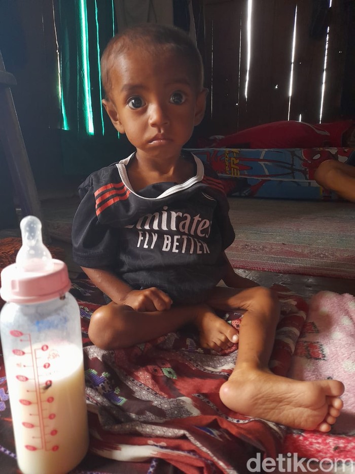 Pilu bocah penderita gizi buruk asal Dompu NTB